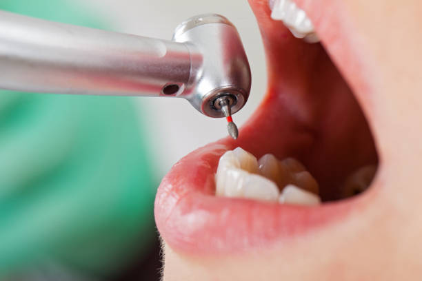 Best Broken or Cracked Tooth Emergency Dentist in Clarksburg, MD